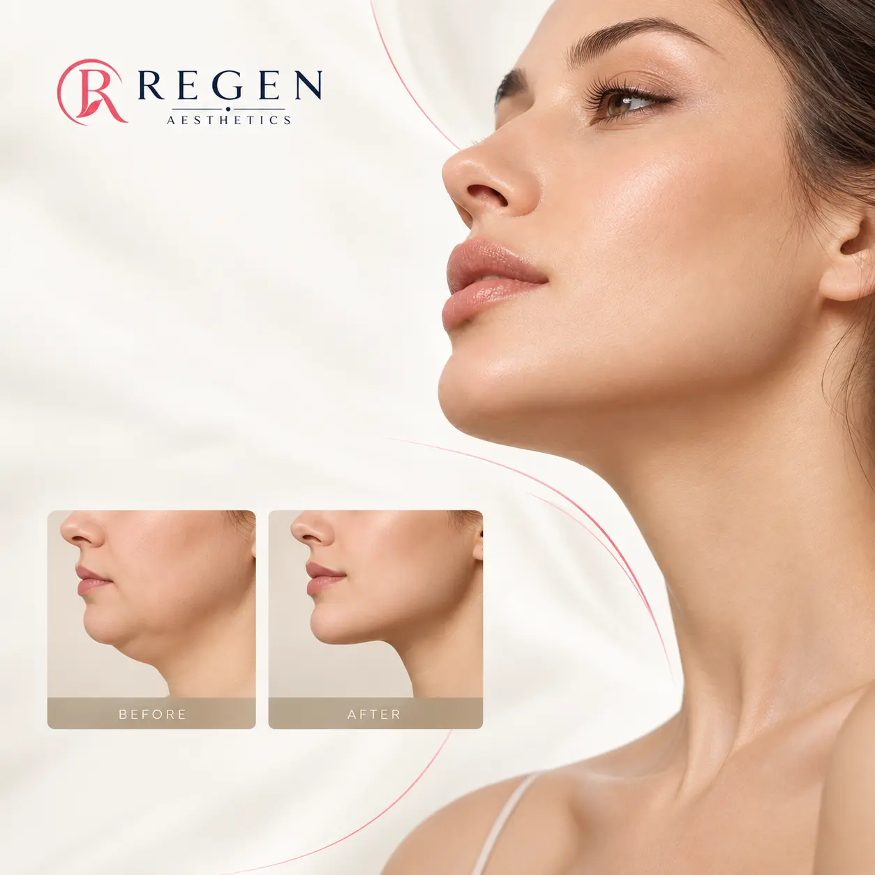 Double Chin Liposuction consultation at REGEN